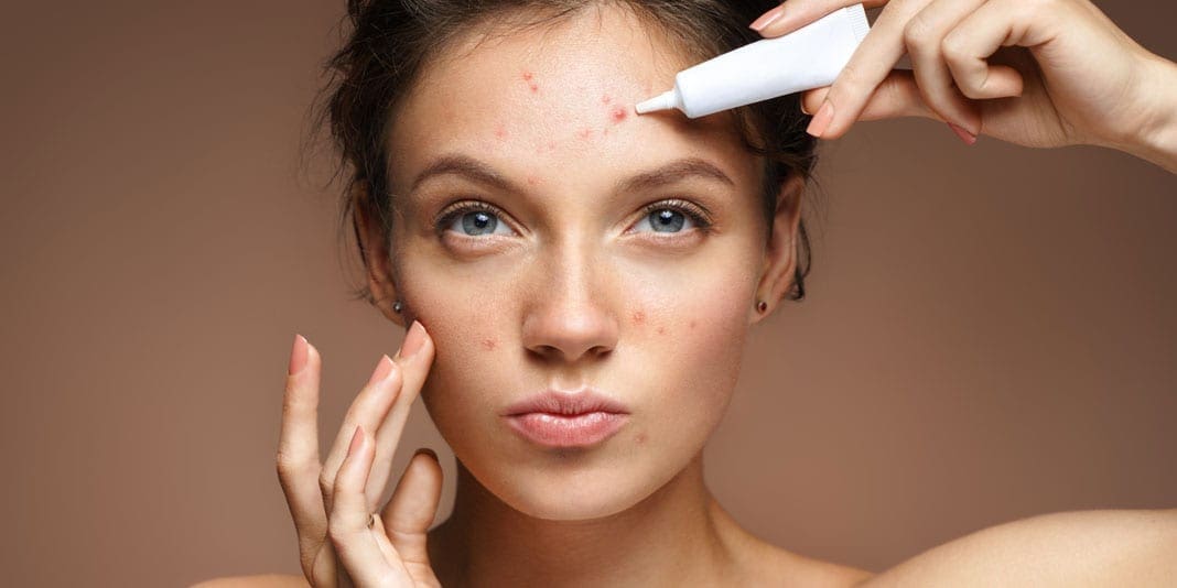 Signs Your Hormones Might Be To Blame For Your Adult Acne Youbeauty